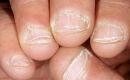 Que se passe-t-il si la plaque à ongles sort du doigt ?